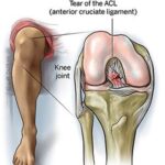 ACL Injuries: Causes, Prevention, and Treatment